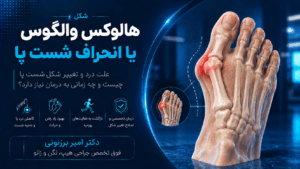 هالوکس والگوس