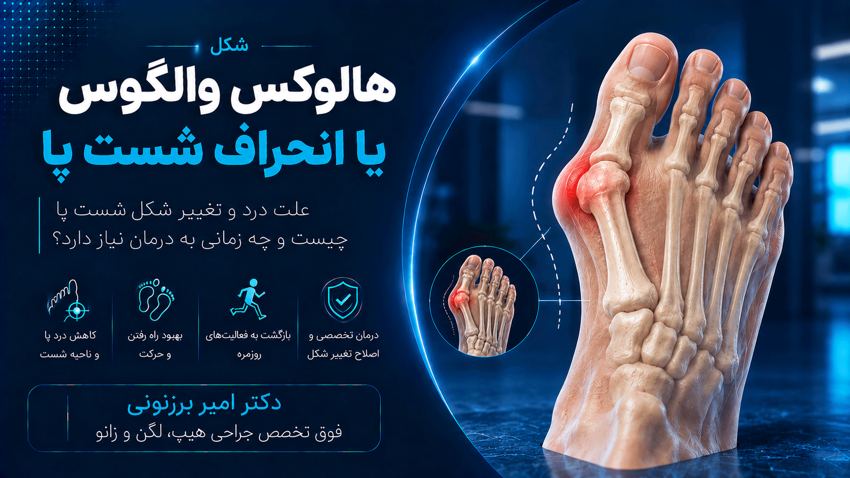 هالوکس والگوس