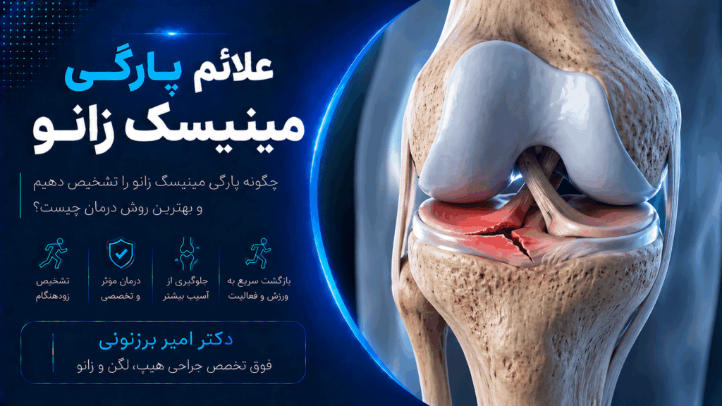 6 علامت پارگی منیسک زانو به همراه درمان آن
