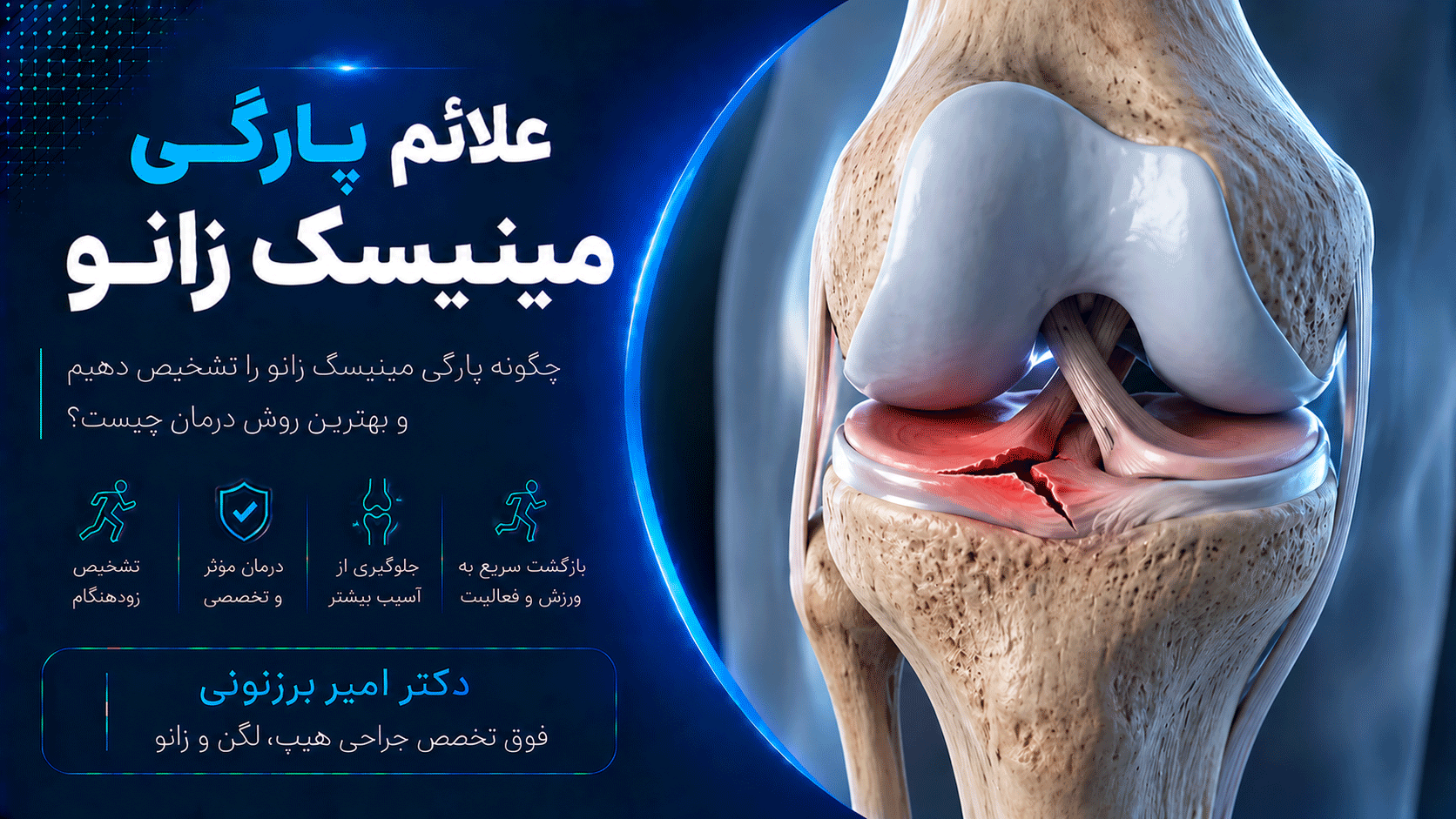 6 علامت پارگی منیسک زانو به همراه درمان آن